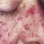 flat head syndrome